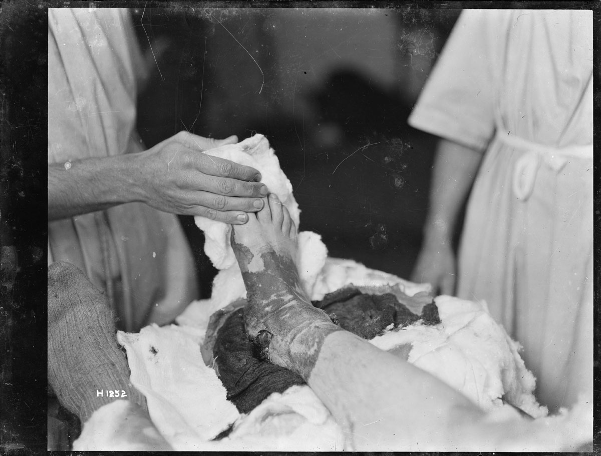 A photograph of a soldier's ankle wound, taken at a 2nd New Zealand Field Ambulance medical station.